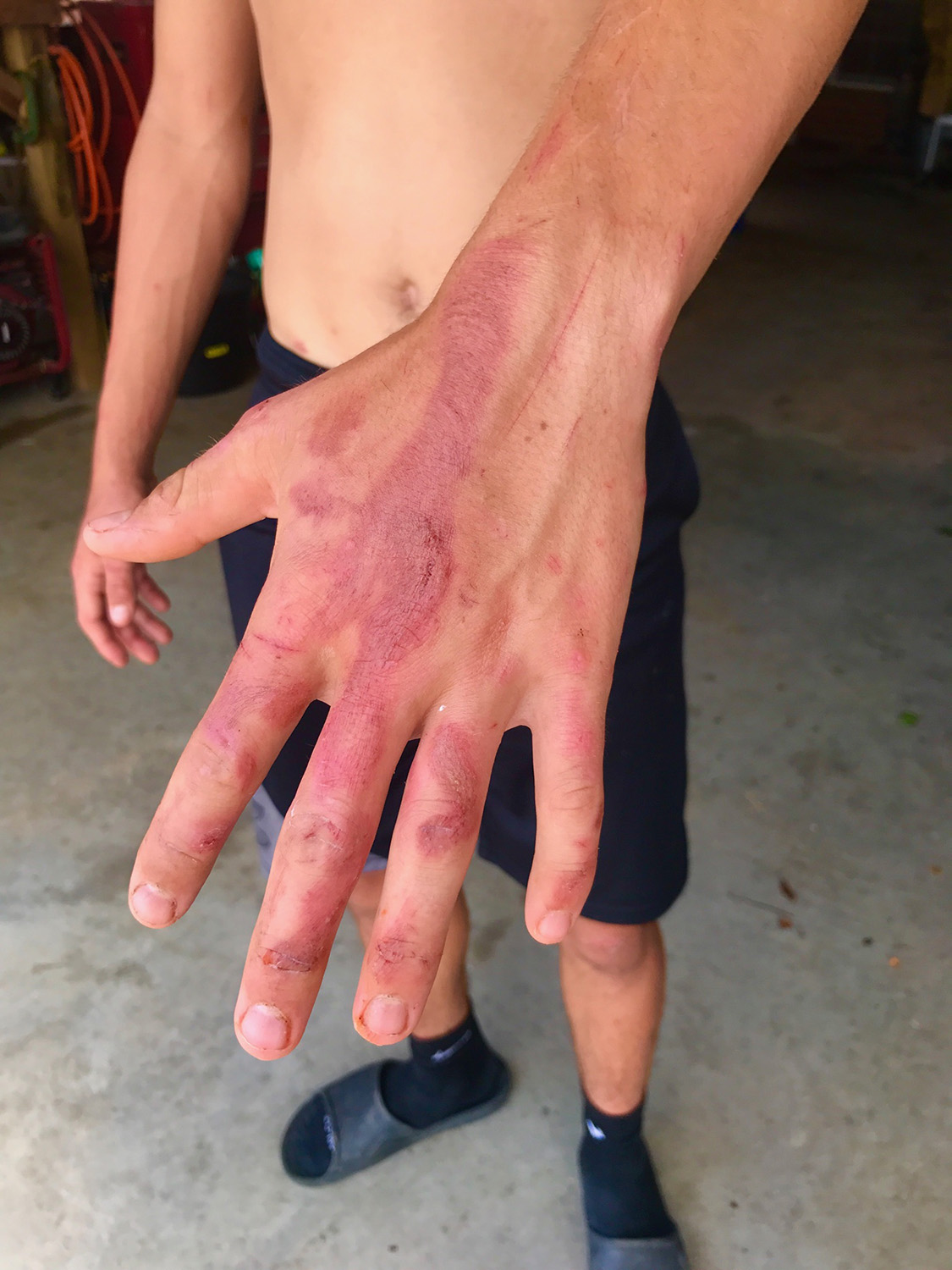 Gage Williams' hand